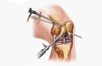 Knee Arthroscopy Treatment by Dr Himanshu Khurana in Mulund