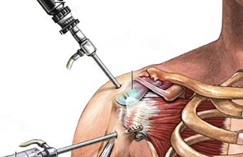 Shoulder Arthroscopy Treatment by Dr Himanshu Khurana in Mulund