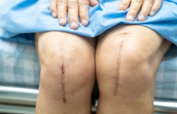 Total Knee Replacement Treatment by Dr Himanshu Khurana in Mulund