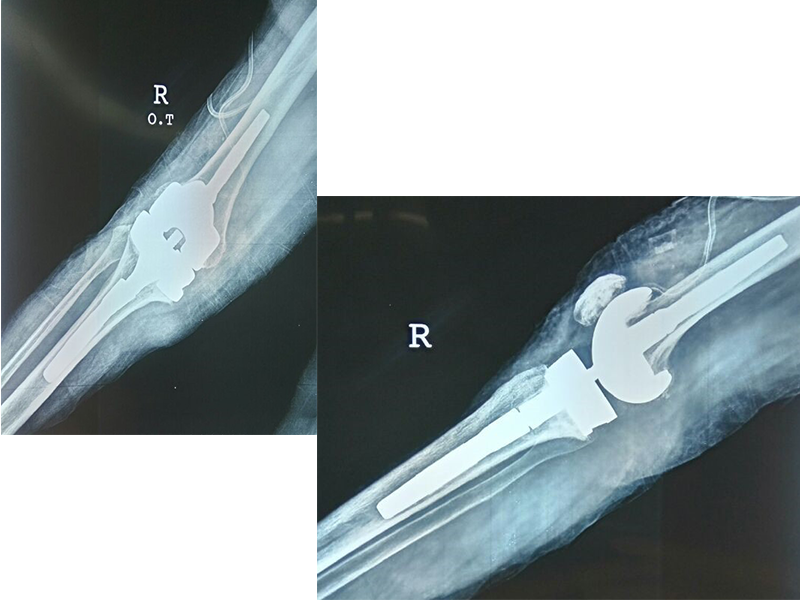 knee_replace_after