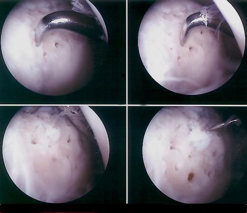 arthroscopy2