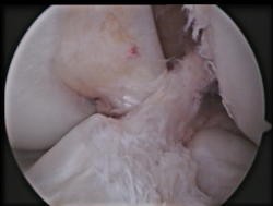 arthroscopy5