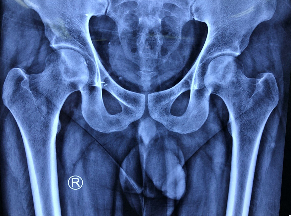 x-ray-of-AVN-both-hips