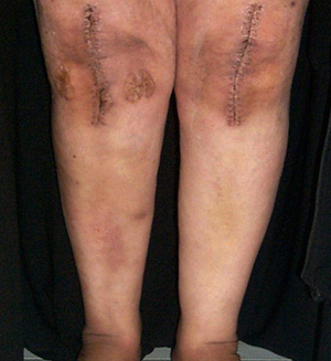 Bow legs corrected after Knee replacement