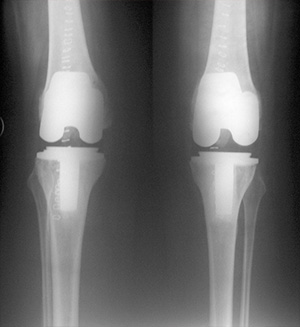 X-rays after both sides knee replacement