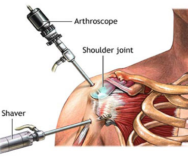 Shoulder Arthroscopy