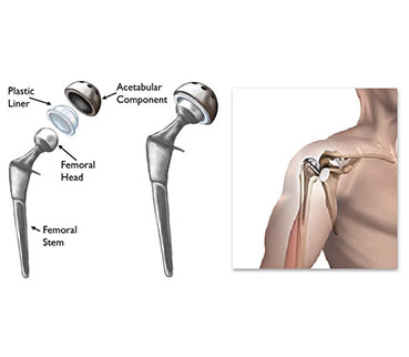 Shoulder Replacement