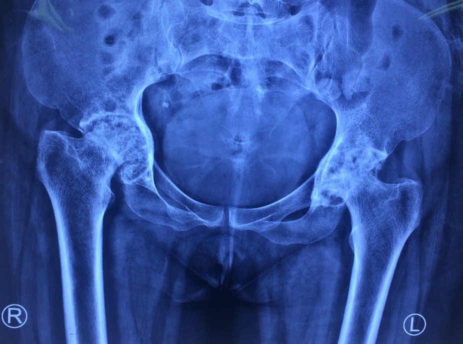 Total Hip Replacement