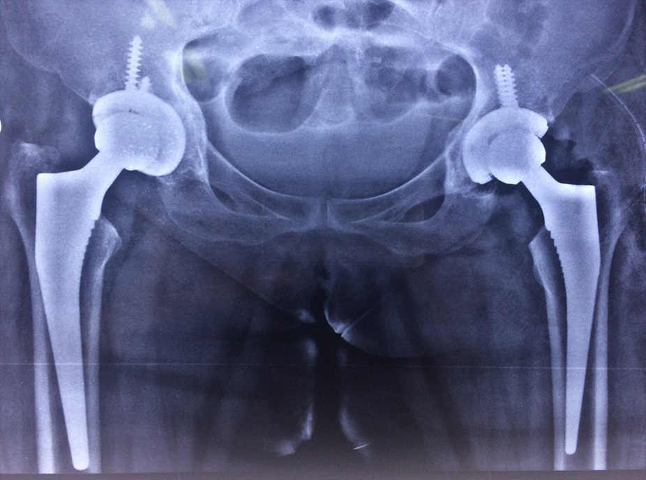 totalhipreplacement2